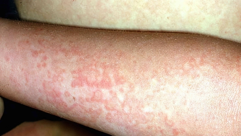 Explore proper Fifth Disease (Erythema infectiosum) treatment options