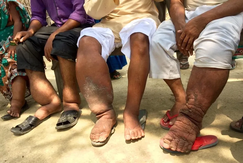 Infographic explaining what is elephantiasis disease
