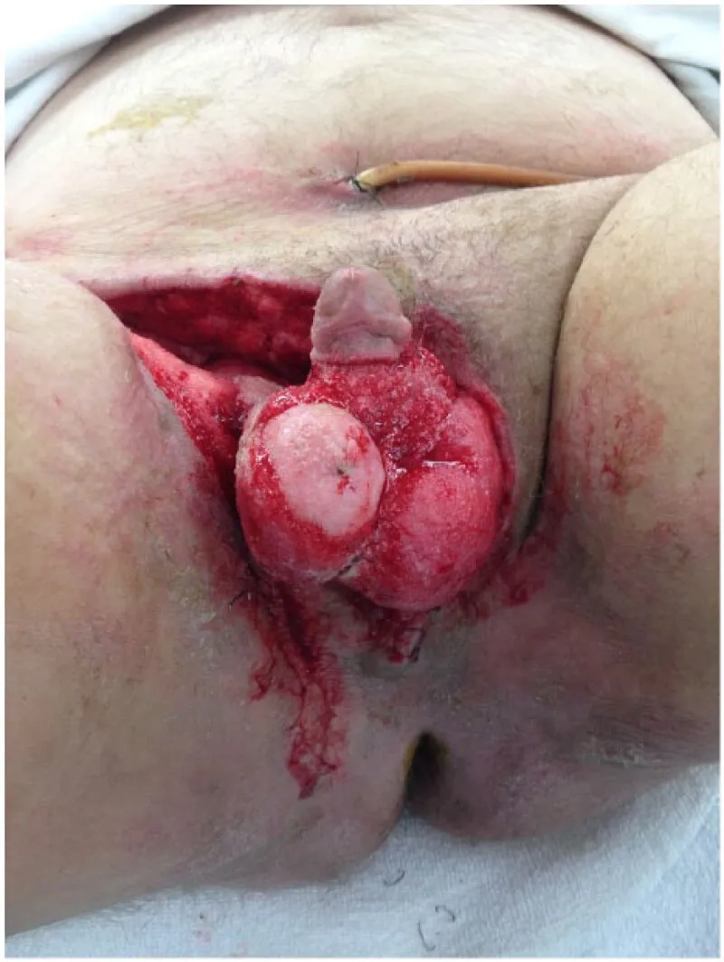 An infographic explaining what is Fournier's gangrene