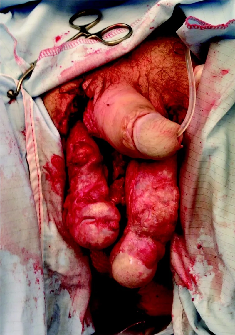 Anatomical view of necrotizing fasciitis of the perineum