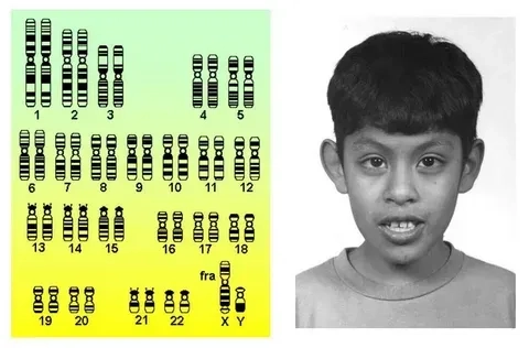Fmr1 gene mutation linked to fragile x condition