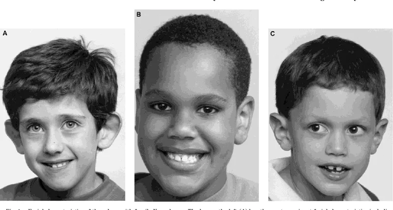 Fragile x syndrome treatment and care strategies