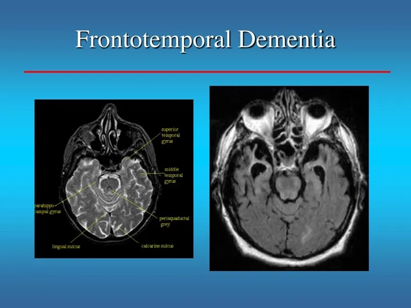 Actor Bruce Willis, who has an FTD diagnosis