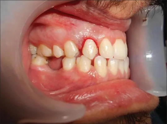 A close-up view of Vincent's angina in the oral cavity