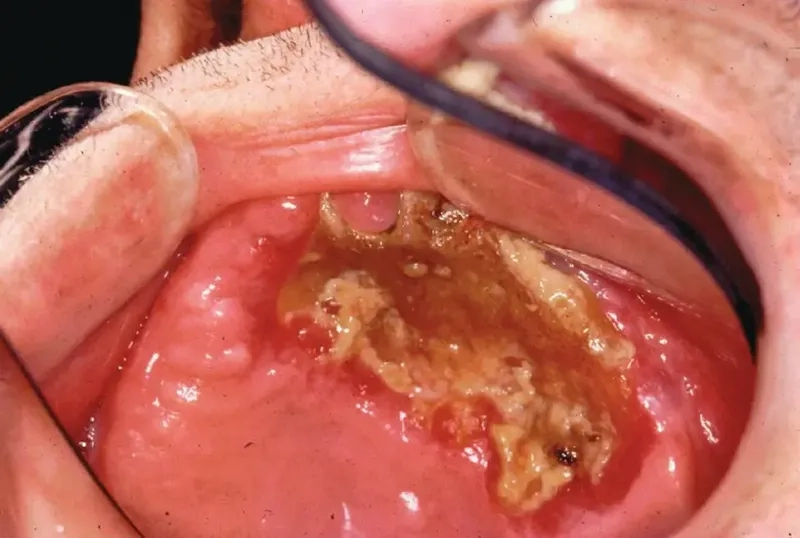 Visual signs of fusospirochetal disease symptoms