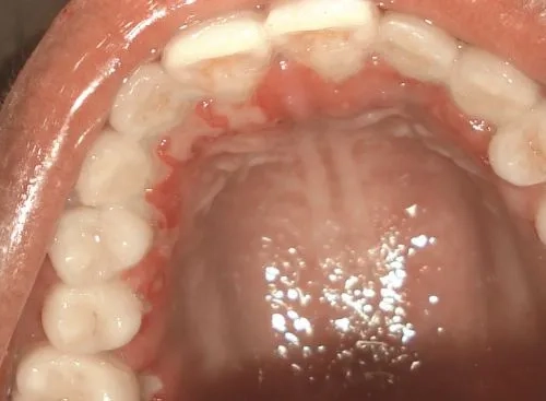 Effective fusospirochetal gingivitis treatment options