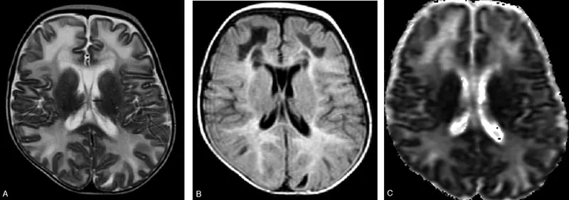 The genetic inheritance pattern of classic galactosemia