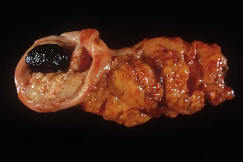 Diagram explaining what is gallbladder cancer