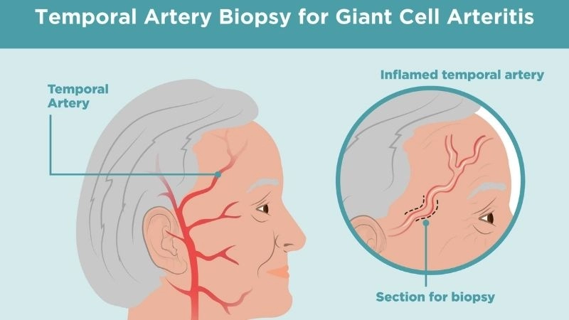Giant cell arteritis treatment with medical care