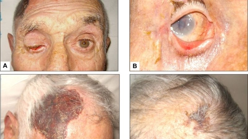 GCA recurrence and long term patient concerns
