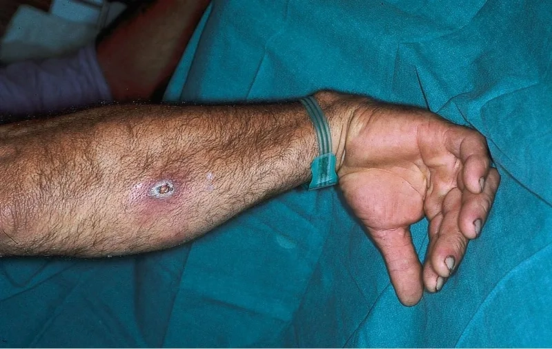 Lesions showing the progression of glanders in humans