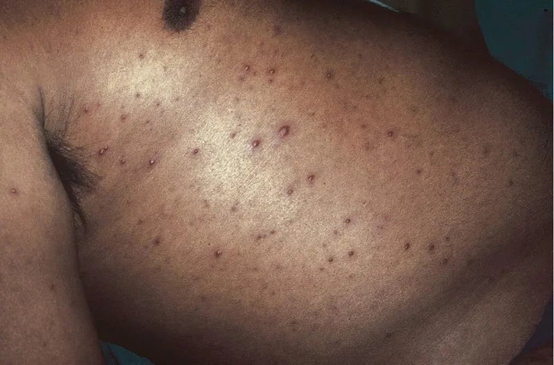 Clear clinical signs of glanders in horses