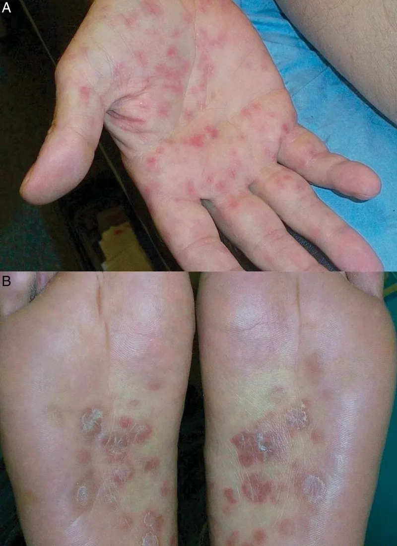 Key gonorrhea symptoms in men to know