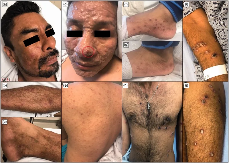 Recognizing common gonorrhea symptoms