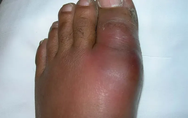 Gout treatment and effective care options