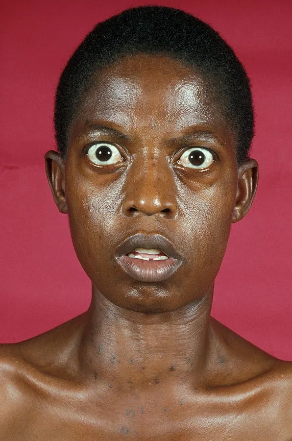 Graves' disease symptoms and clinical indicators