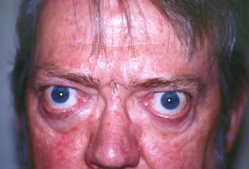 Thyroid eye disease linked to graves' condition