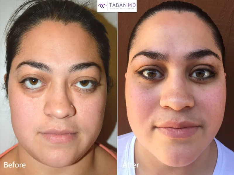 Hyperthyroidism caused by graves' disease