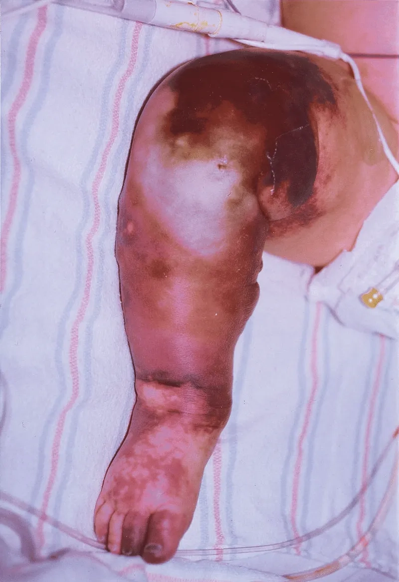 How Haemophilus influenzae is contagious through droplets