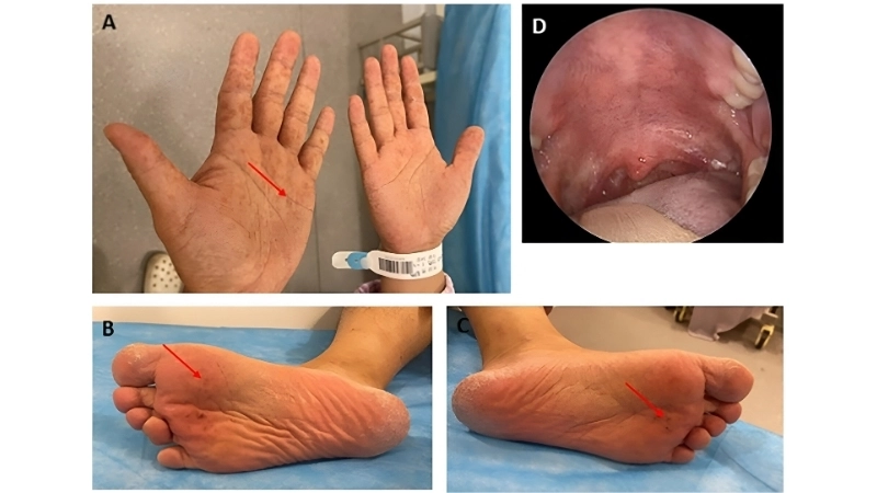 Hand Foot and Mouth Disease prevention methods