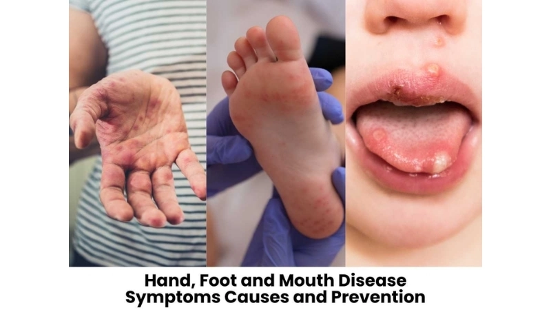 Hand Foot and Mouth Disease treatment tips safe