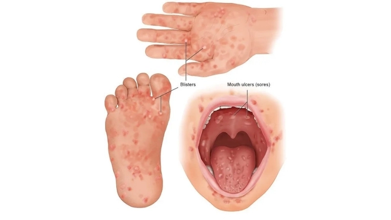 Hand Foot and Mouth Disease pictures clear view