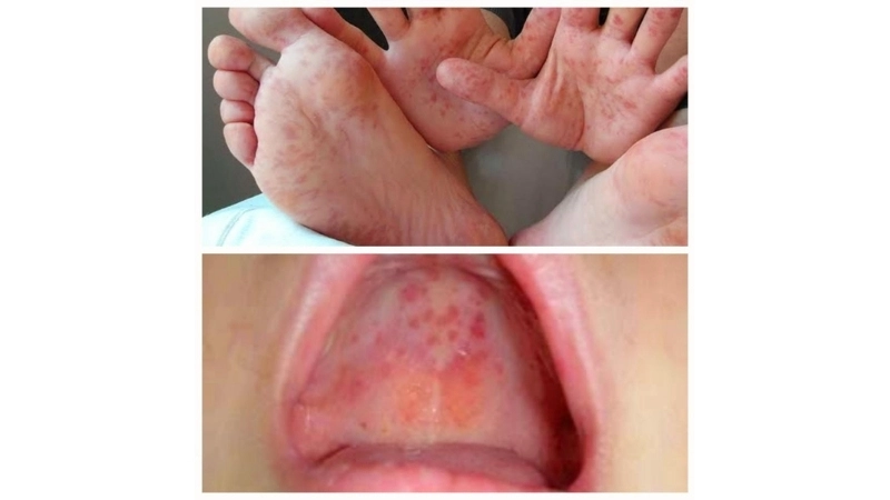 Is Hand Foot and Mouth Disease contagious info
