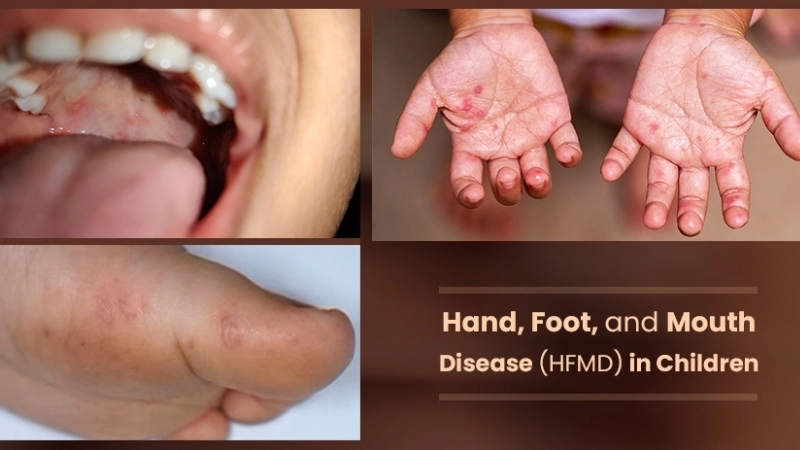 Hand Foot and Mouth Disease rash signs visible