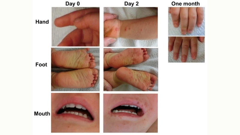 CNS involvement in HFMD can lead to brain damage