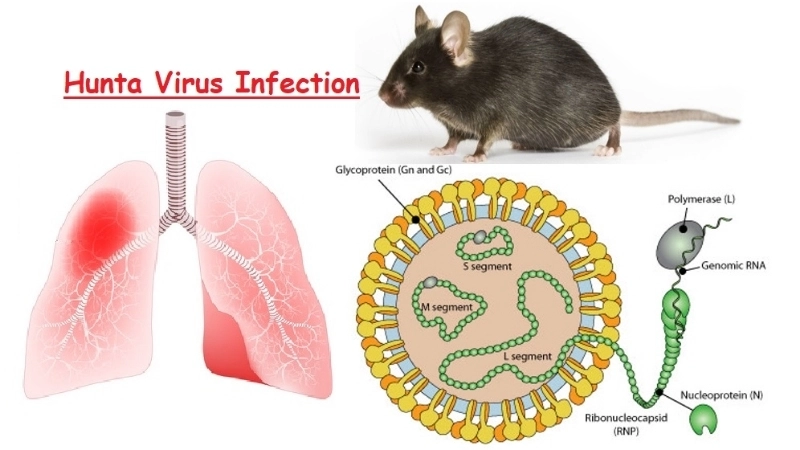 Learn proper Hantavirus treatment steps