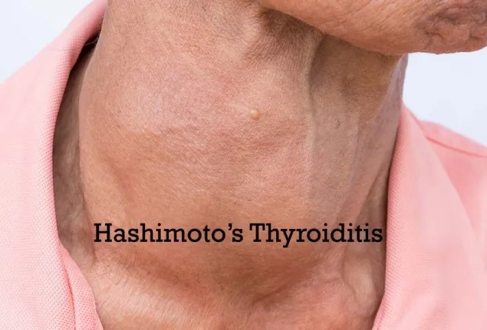 Hypothyroidism linked to hashimoto's disease