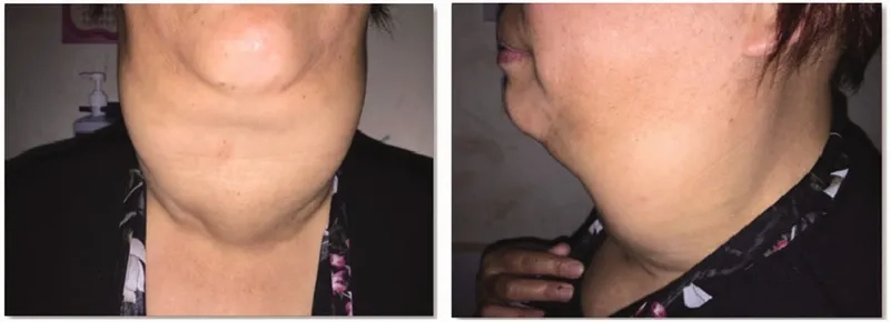 Tpo antibodies and hashimoto's diagnosis marker