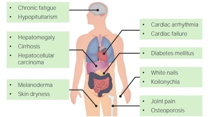 Rising risks of iron overload heart failure
