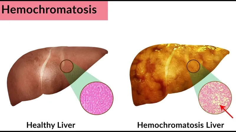 Hemochromatosis symptoms from excess iron buildup