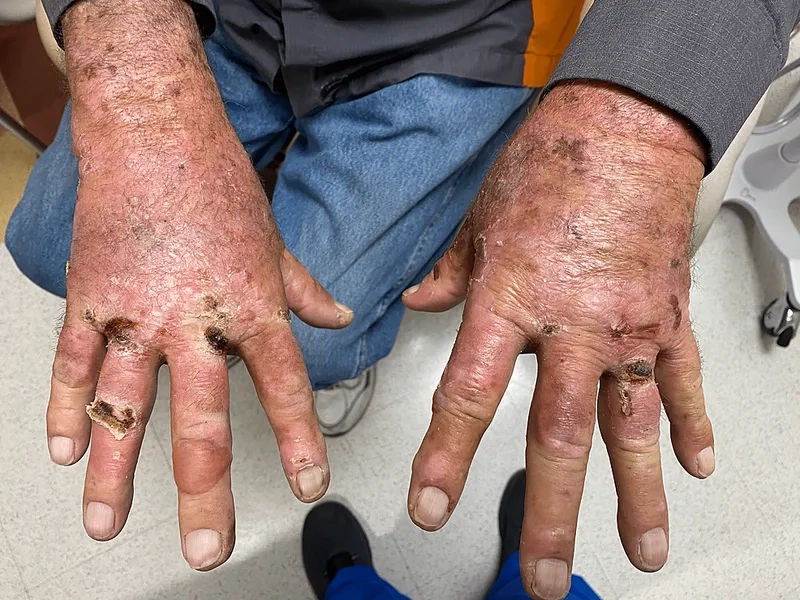 What is hemochromatosis explained in medicine