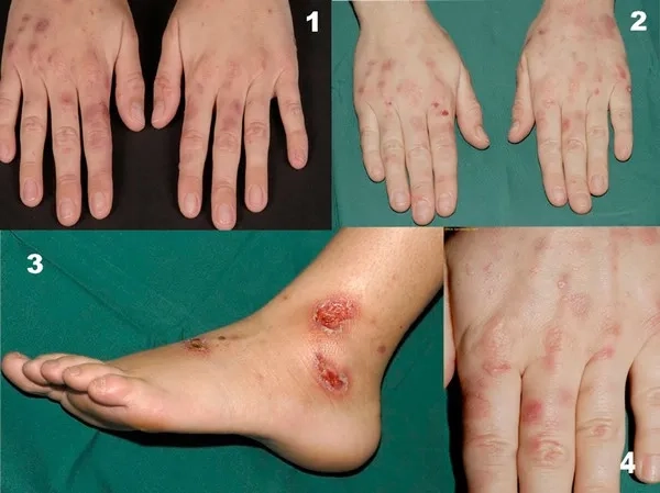 Iron overload affecting organs and body health