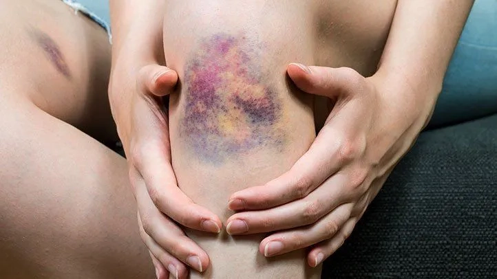 Recognizing the common hemophilia symptoms