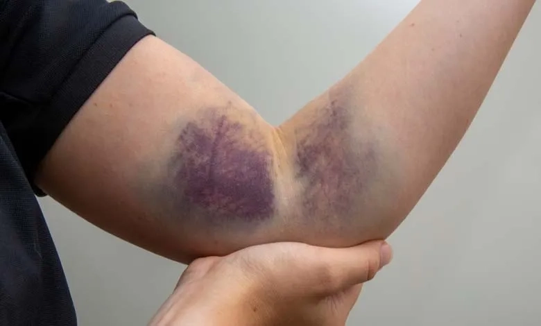 Comparing the different types of hemophilia