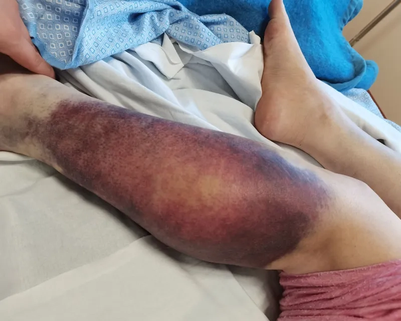 Exploring if is hemophilia curable today