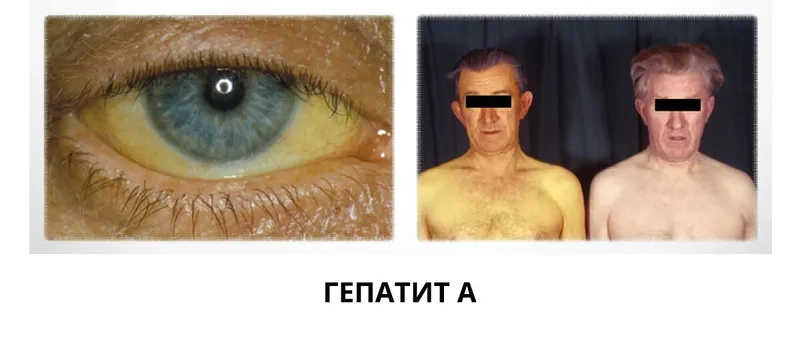 Overview of supportive care and hepatitis a treatment