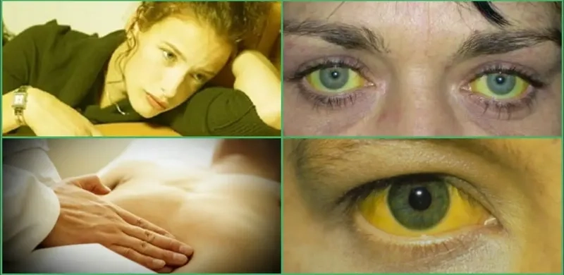 An illustration of how is hepatitis a transmitted