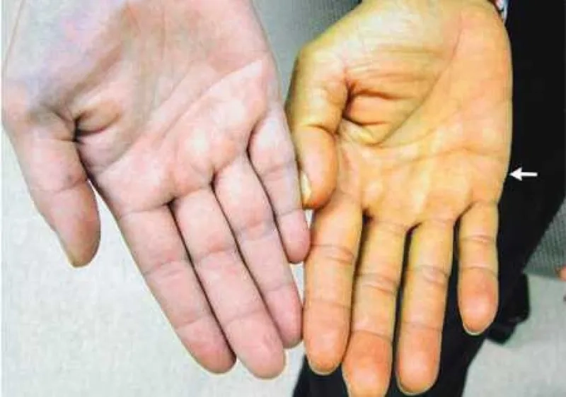 Rare but potential long term effects of hepatitis a