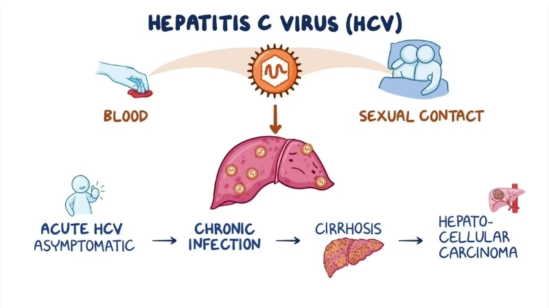 Hepatitis C chronic HCV infection info