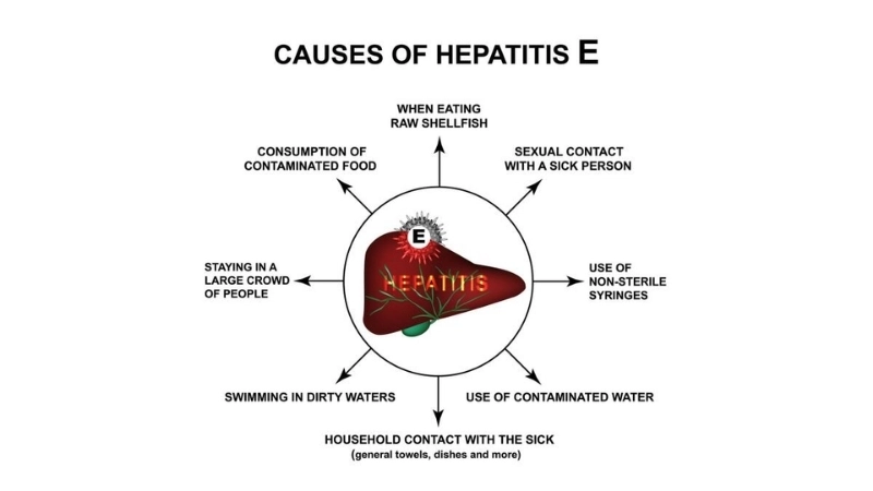 Hepatitis E virus linked to Hepatitis E