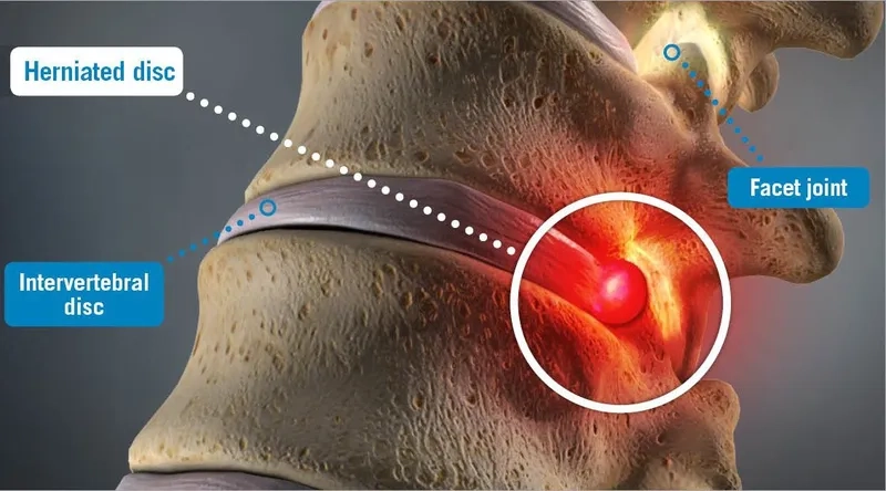 An MRI showing a lumbar herniated disc