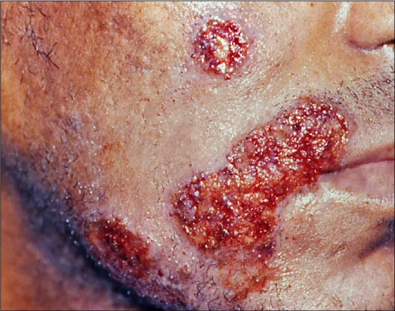 Understanding the periods when herpes is contagious