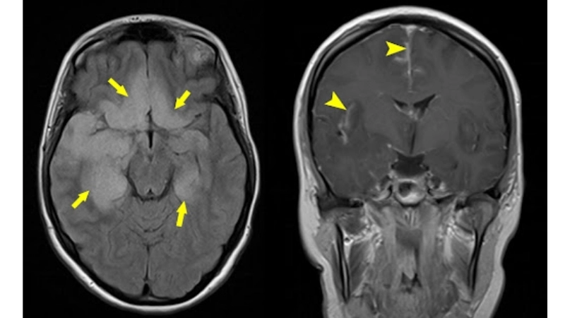 Herpes simplex virus can trigger HSE early