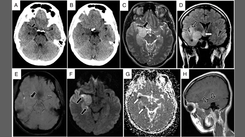 HSE treatment relies on timely aciclovir use