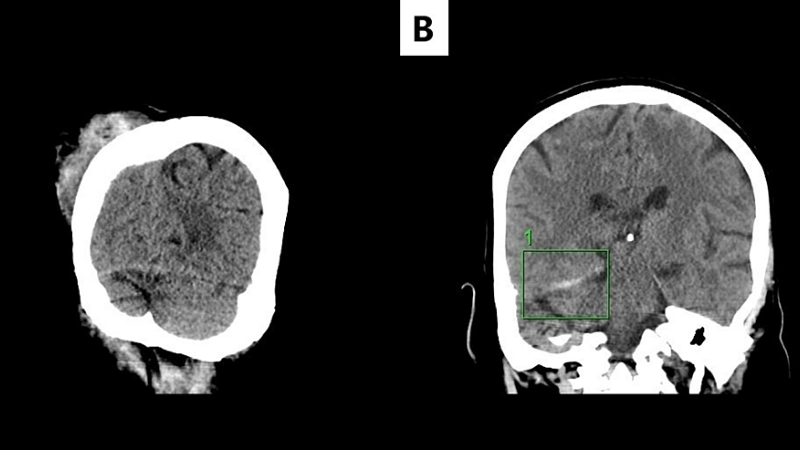 Aciclovir helps reduce herpes brain infection risk