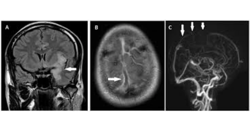 Brain infection may result from HSV or HSE